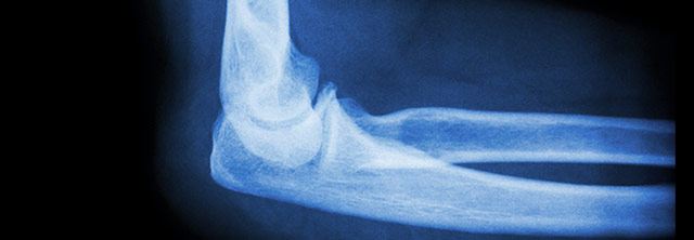 X-ray image of elbow. Pediatric Orthoprdic Andrew E. Price MD