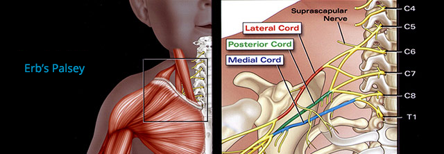 Erb's Palsy injury diagram Andrew E Price