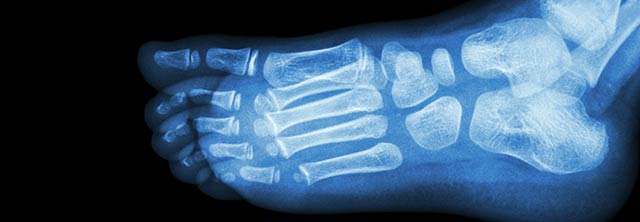 X-ray image of foot pediatric orthopedic Andrew E. Price MD