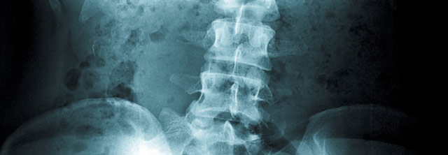 X-ray image of spine pediatric orthopedic Andrew E. Price MD