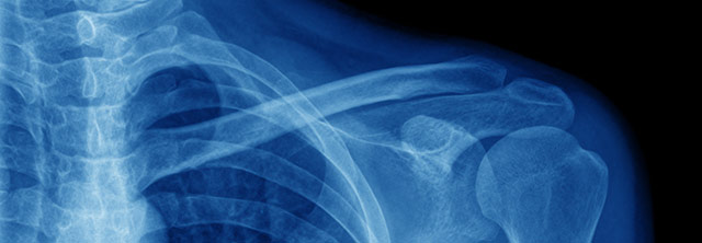 X-ray image of shoulder Pediatric Orthopedic Brachial Plexus Andrew E. Price MD